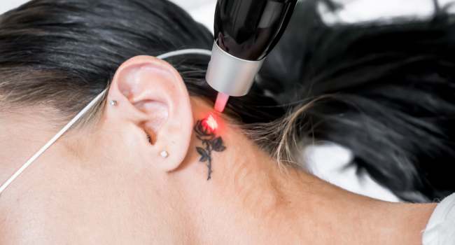 laser tattoo removal treatment